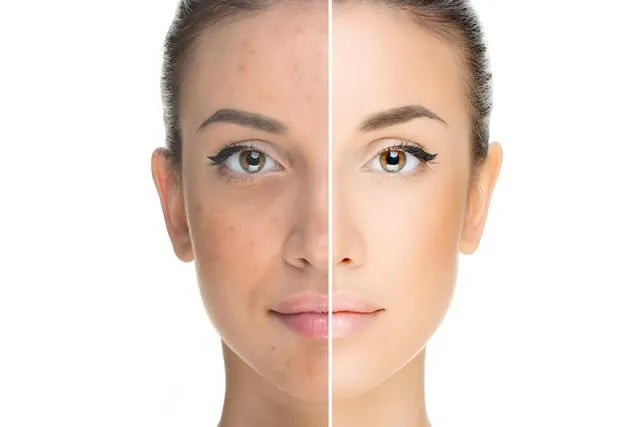 I benefici della preparazione della pelle del viso all'esposizione al sole con una pulizia del viso con Hydrafacial